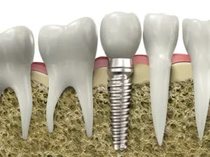 dental implants San Antonio