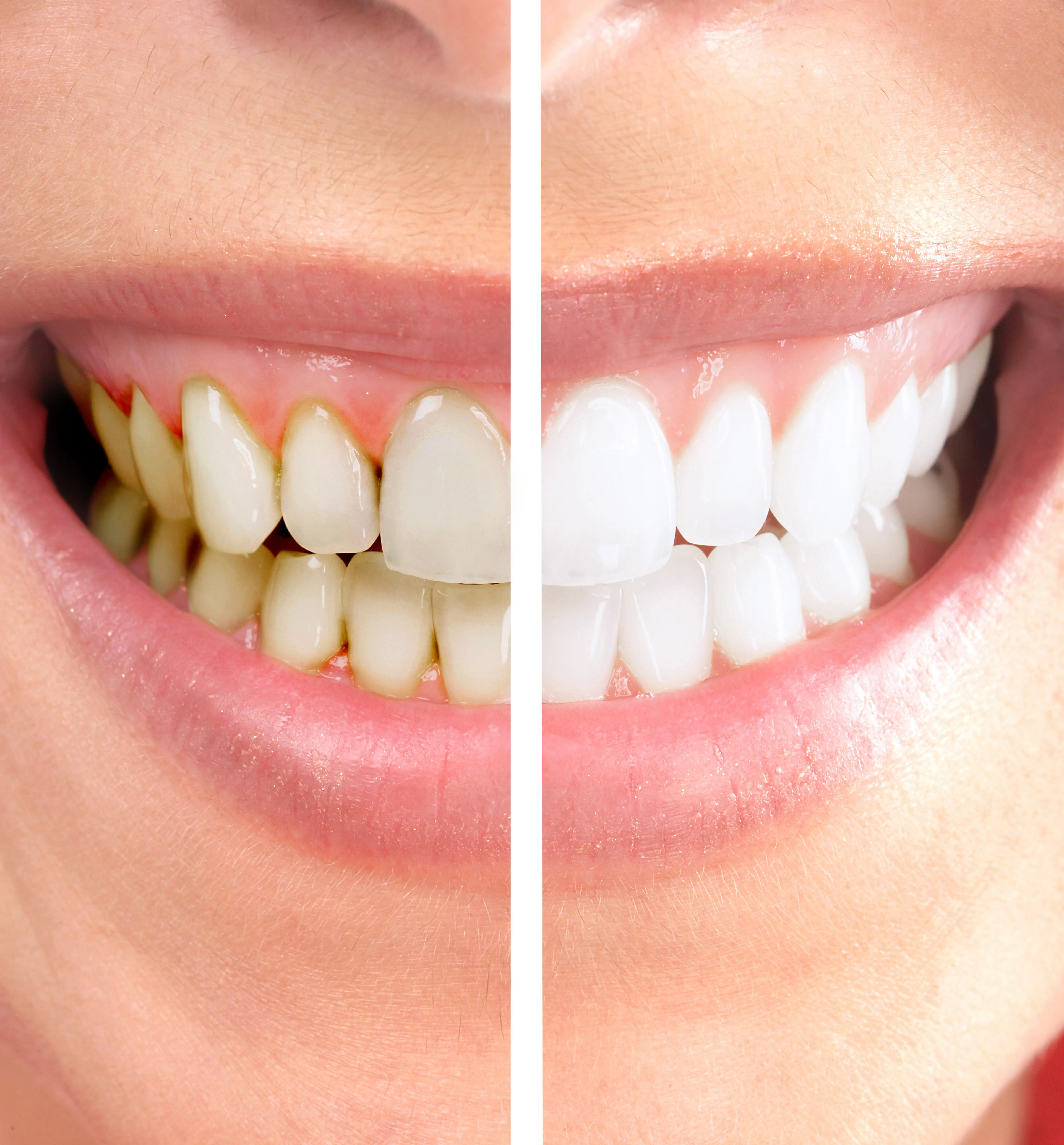 veneers San Antonio