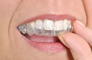  braces San Antonio