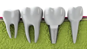 dental implants San Antonio