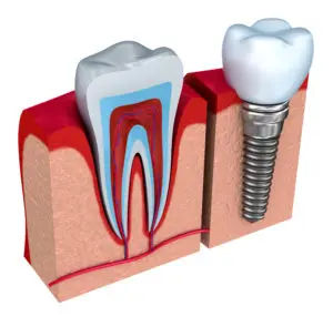 dental bridges San Antonio