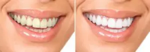 tooth whitening San Antonio