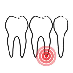 root canal San Antonio