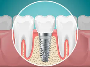 implant dentist San Antonio