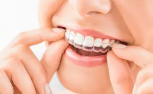 braces San Antonio