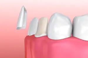 porcelain veneers San Antonio