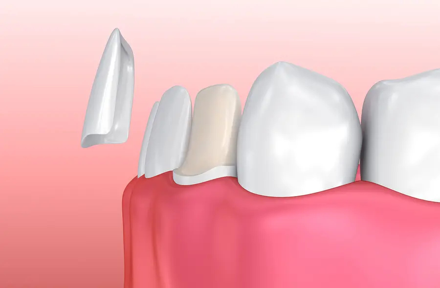 porcelain veneers San Antonio