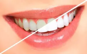 Zoom Whitening San Antonio