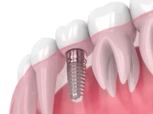 dental implants San Antonio