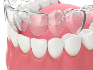 Invisalign San Antonio