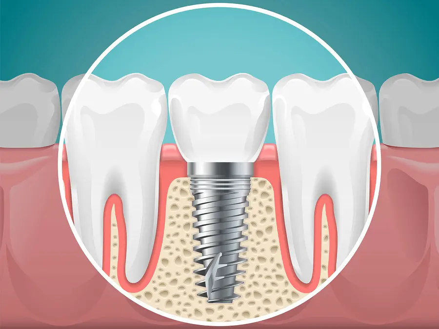 implant dentist San Antonio