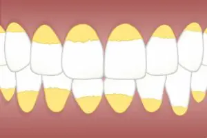tartar buildup