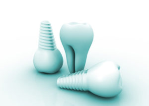dental implants San Antonio