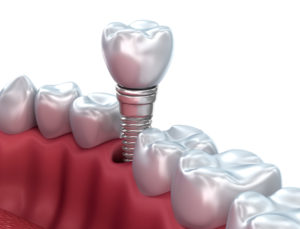 dental implants San Antonio