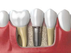 implant dentist San Antonio