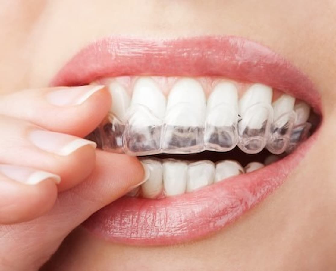 It's over! Going straight to nighttime wear, though? : r/Invisalign